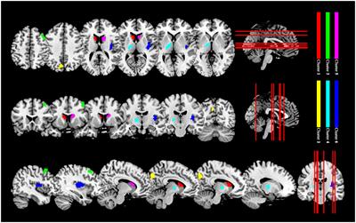 Increased brain iron in patients with thyroid-associated ophthalmopathy: a whole-brain analysis